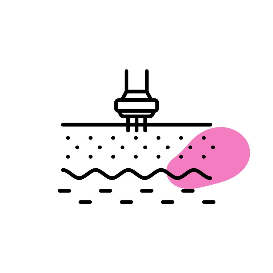 Dermapen (Microneedling)