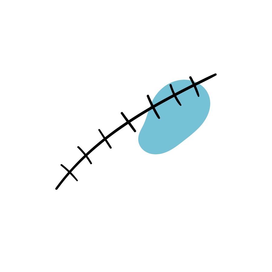 Stitches
